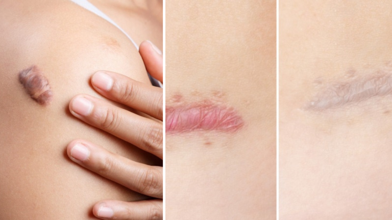 Salud | Queloides: enfermedad, detección y tratamientos en Clínica Merced