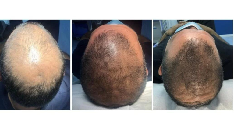 Salud | Alopecia Androgénica: Enfermedad, detección y tratamientos