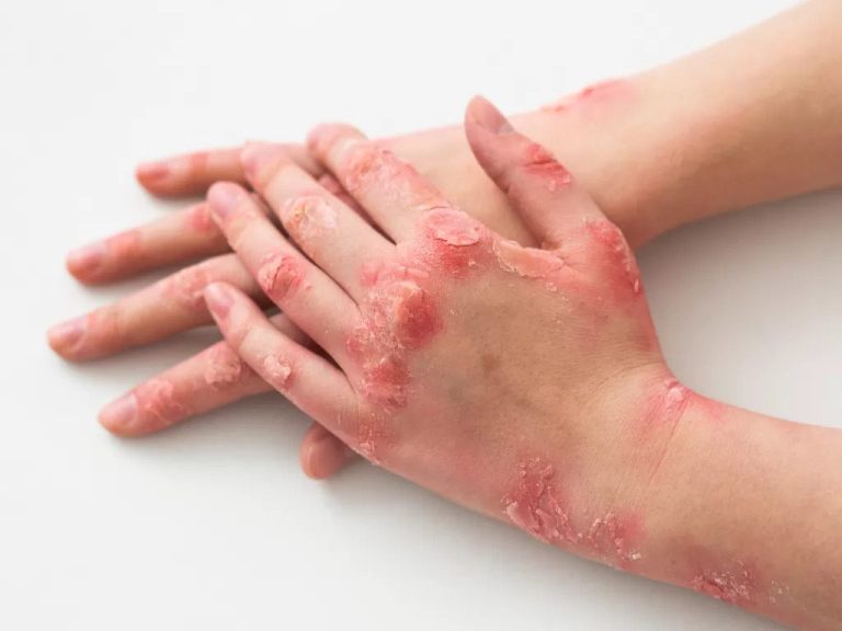 [SALUD] ¿Qué es la Psoriasis y cuál es su tratamiento?