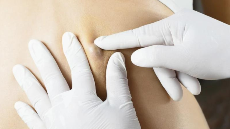 Despidiéndonos de los Lipomas: todo lo que necesitas saber sobre su detección y extracción en Clínica Merced