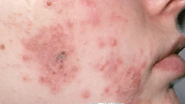 Salud | Hidradenitis supurativa