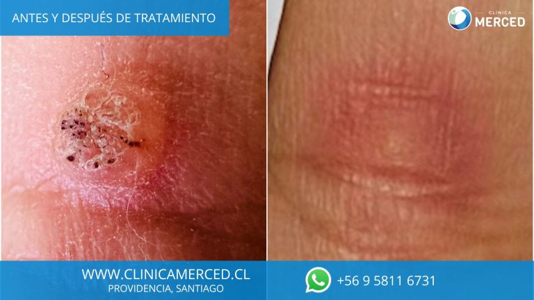 Salud | Verrugas: Causas, Prevención y Tratamientos Especializados en Dermatología