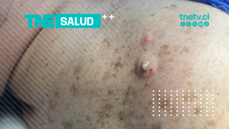 Salud | Dermatólogía: Cuerno Cutáneo